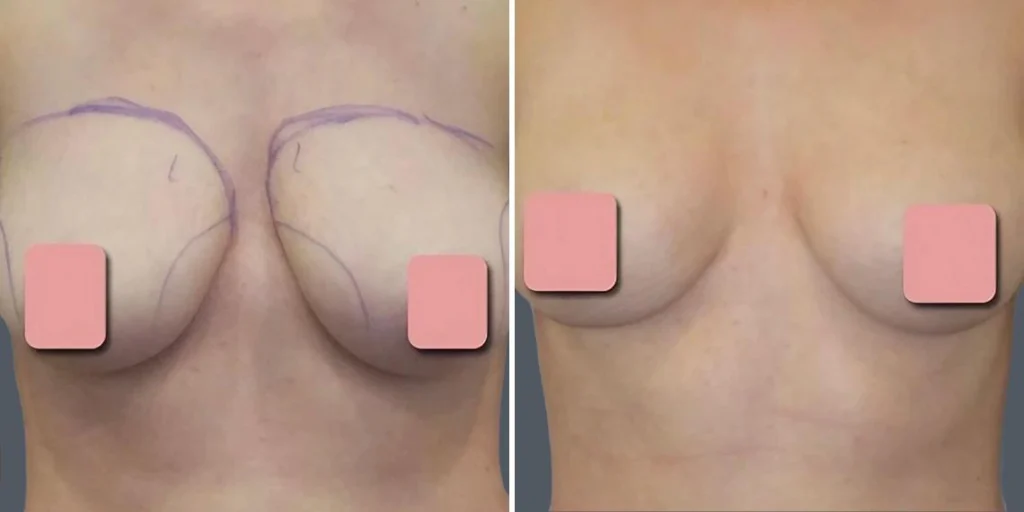 breast liposuction female pre2024 002 before and after before and after