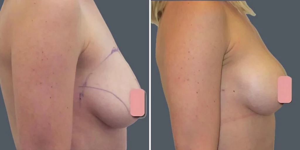 breast liposuction female pre2024 003 before and after before and after