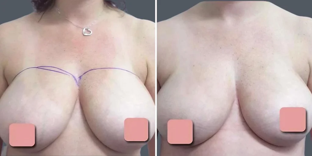 breast liposuction female pre2024 004 before and after before and after