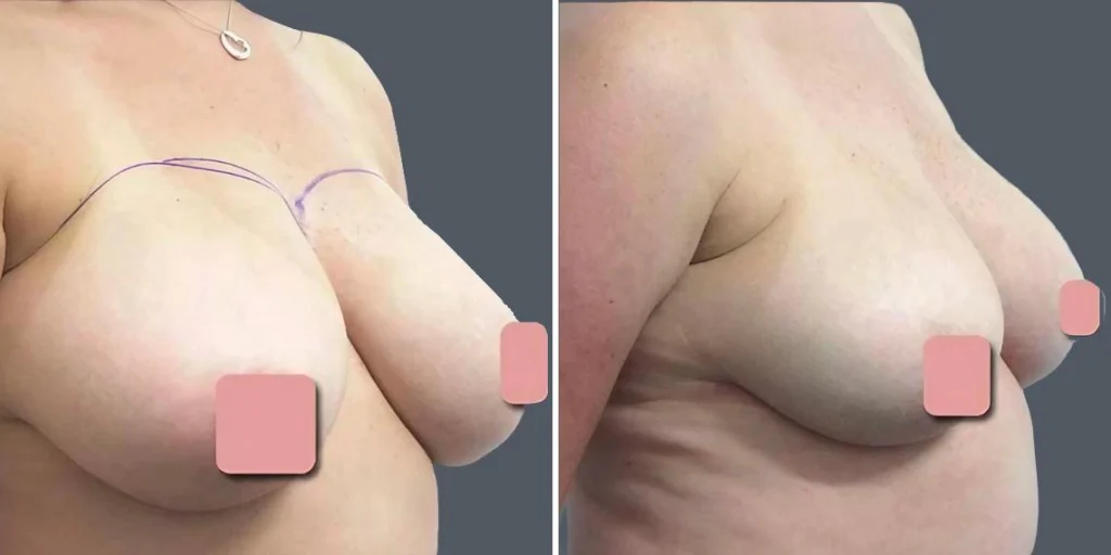 breast liposuction female pre2024 005 before and after before and after