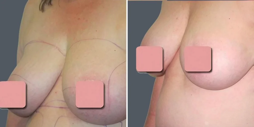 breast liposuction female pre2024 006 before and after before and after