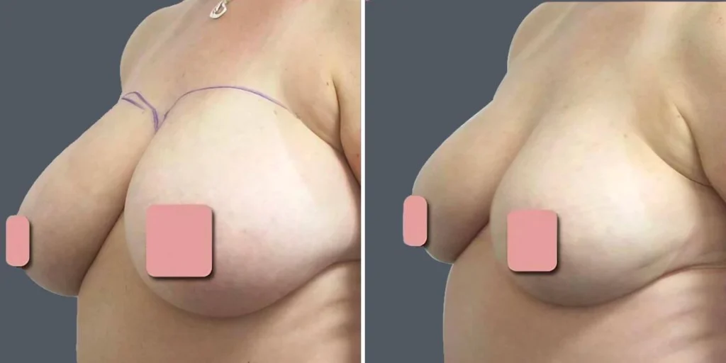 breast liposuction female pre2024 007 before and after before and after