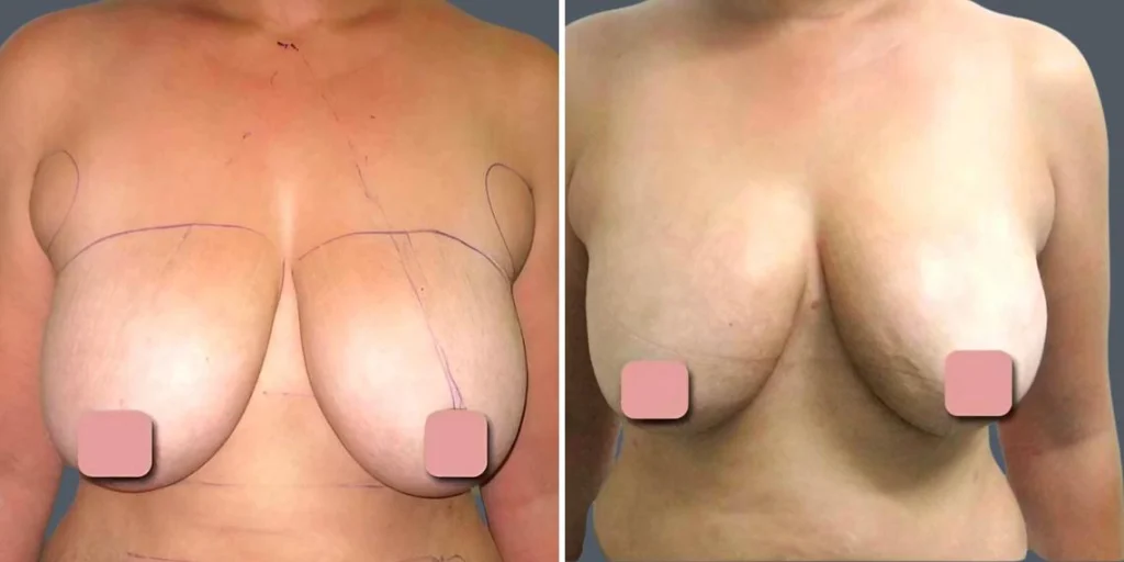 breast liposuction female pre2024 009 before and after before and after