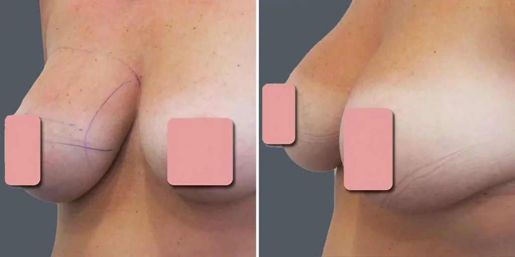 breast liposuction female pre2024 011 before and after before and after