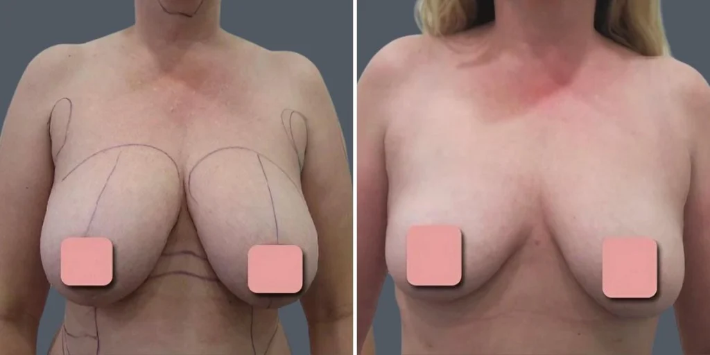 breast liposuction female pre2024 013 before and after before and after