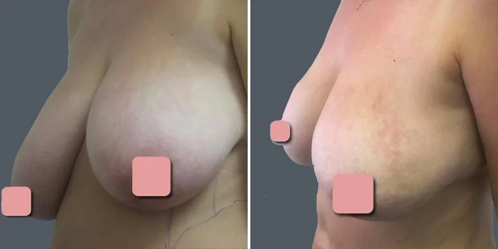 breast liposuction female pre2024 016 before and after before and after