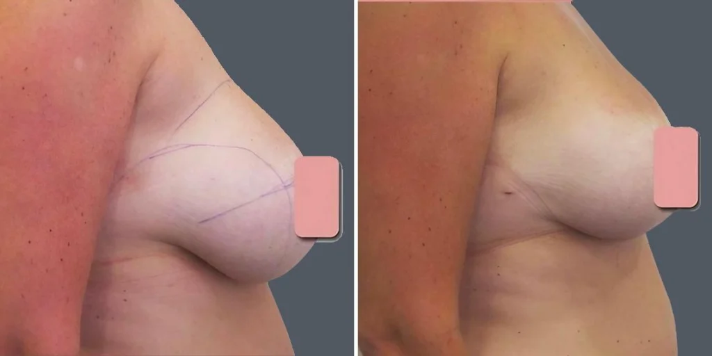 breast liposuction female pre2024 017 before and after before and after