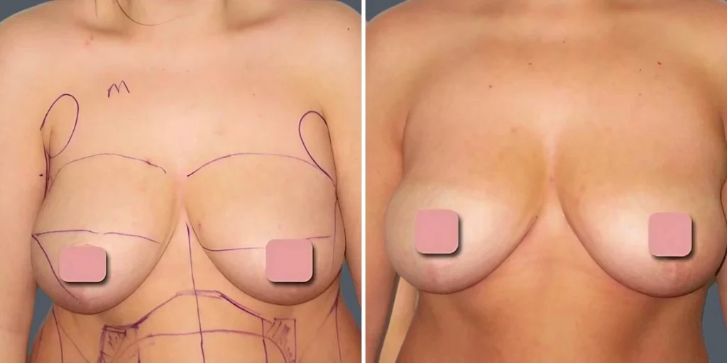 breast liposuction female pre2024 018 before and after before and after