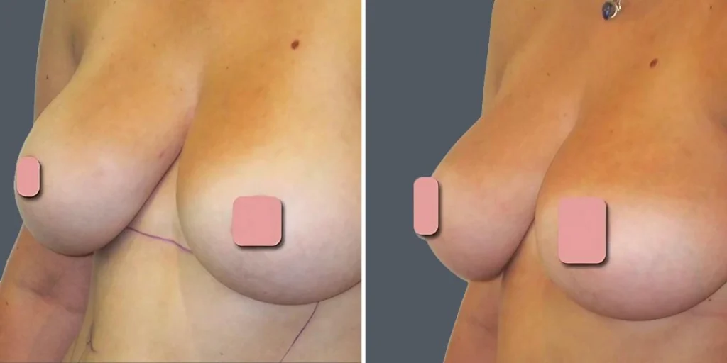 breast liposuction female pre2024 019 before and after before and after