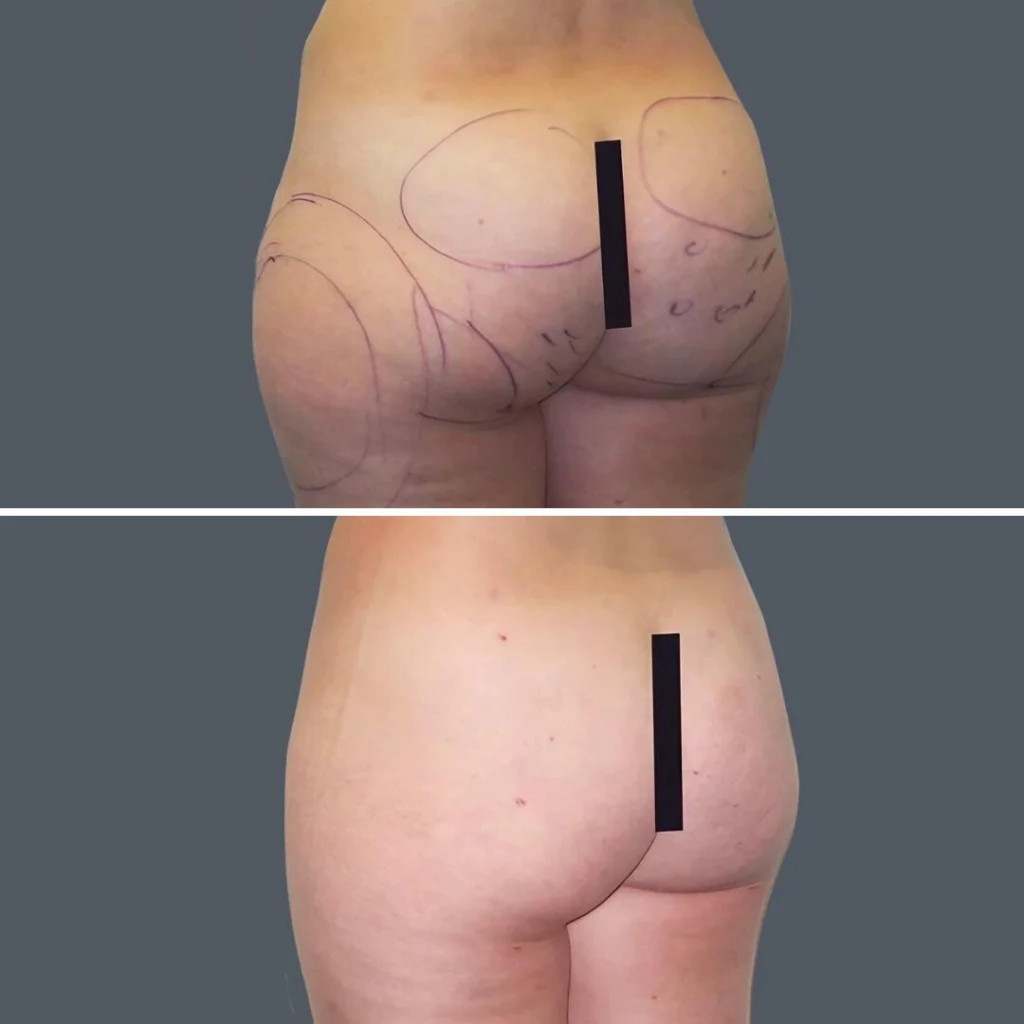 buttock reduction female pre2024 001 before and after before and after
