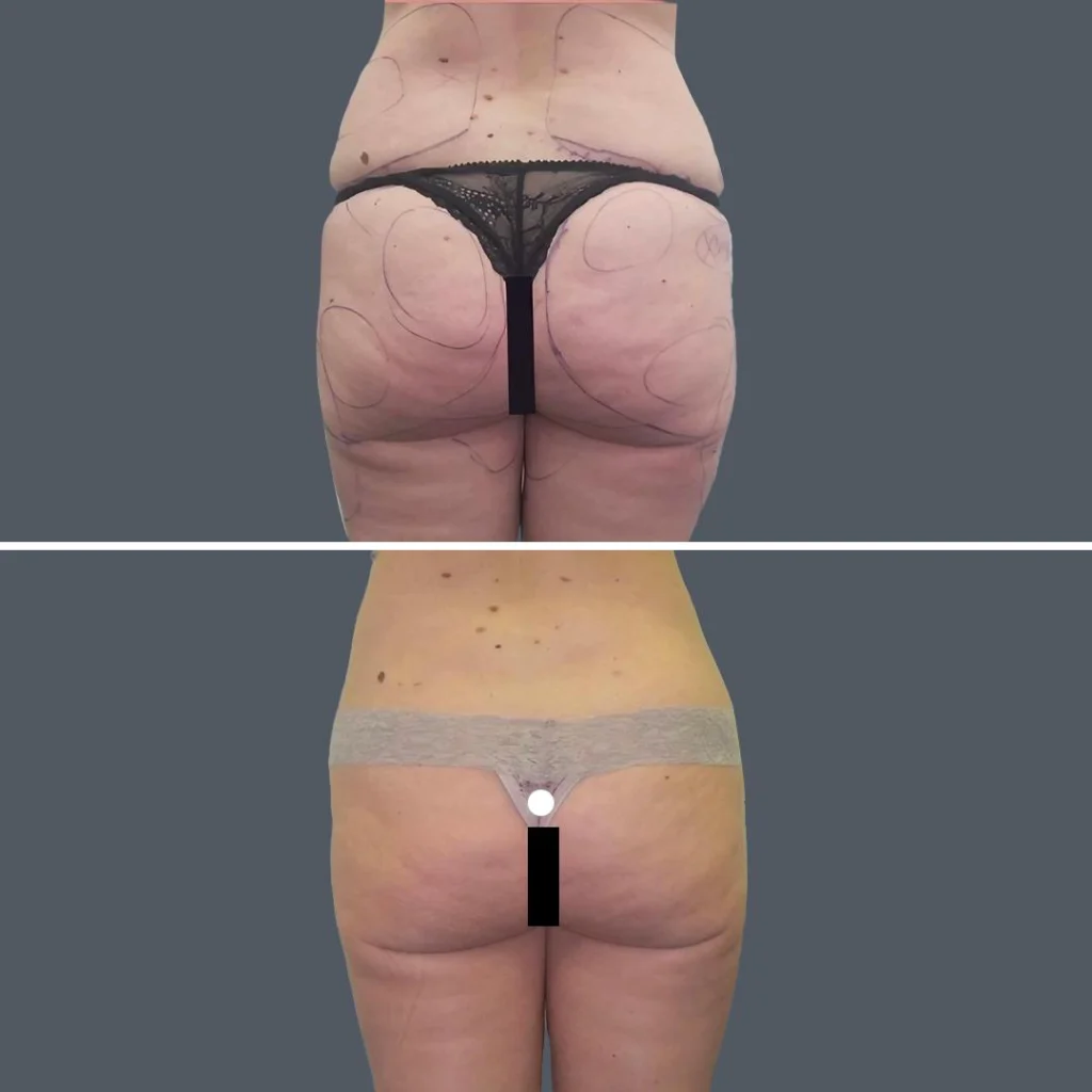 buttock reduction female pre2024 002 before and after before and after