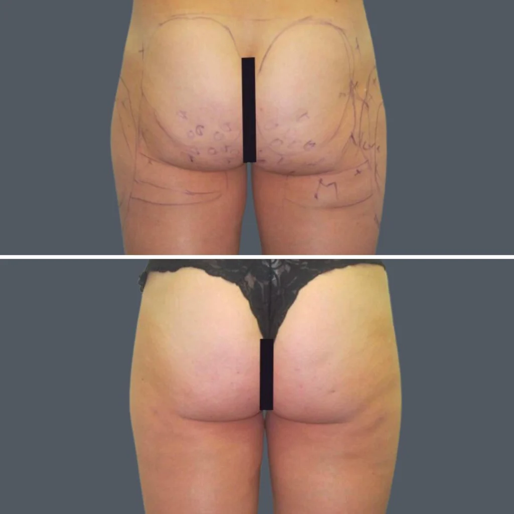 buttock reduction female pre2024 004 before and after before and after