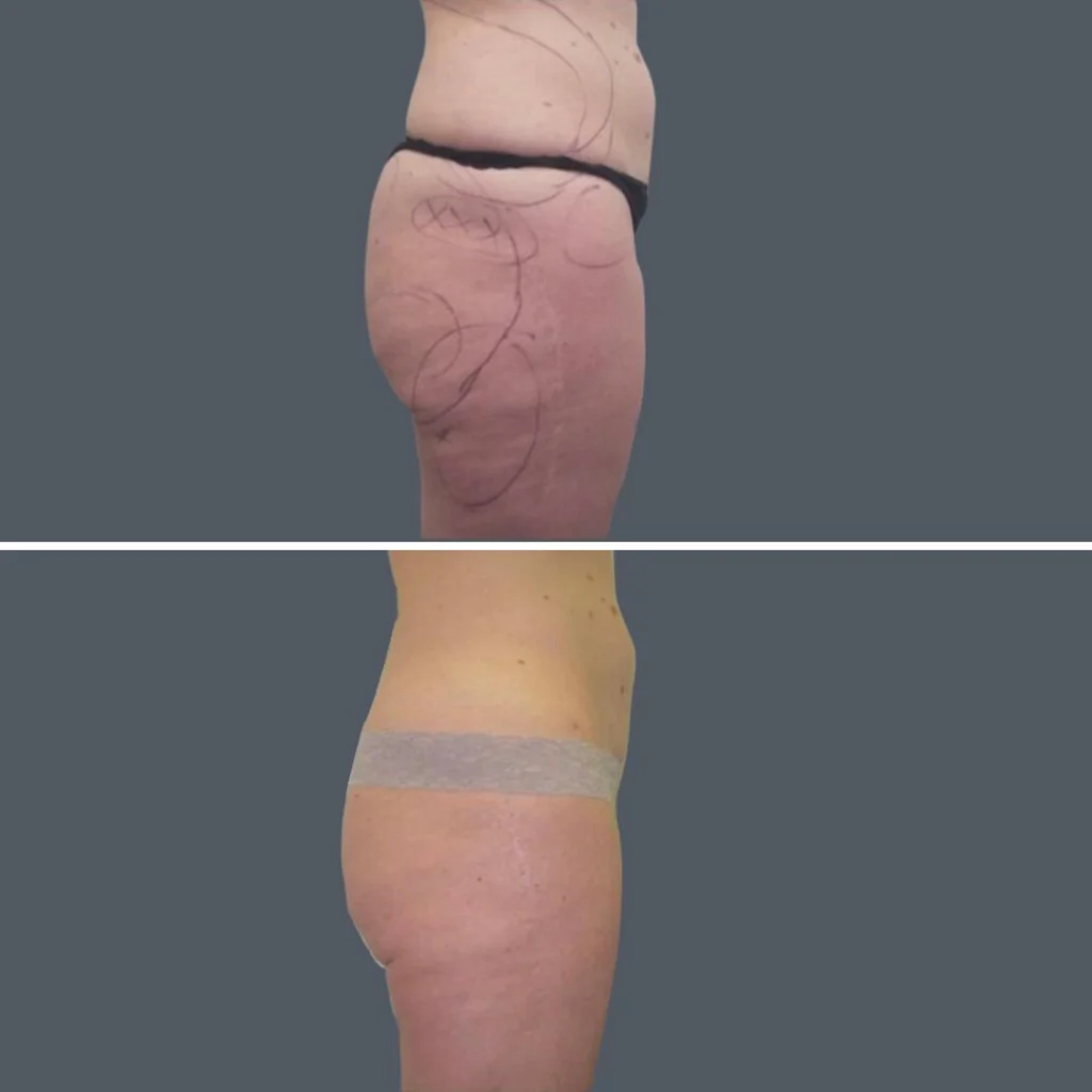 buttock reduction female pre2024 005 before and after before and after