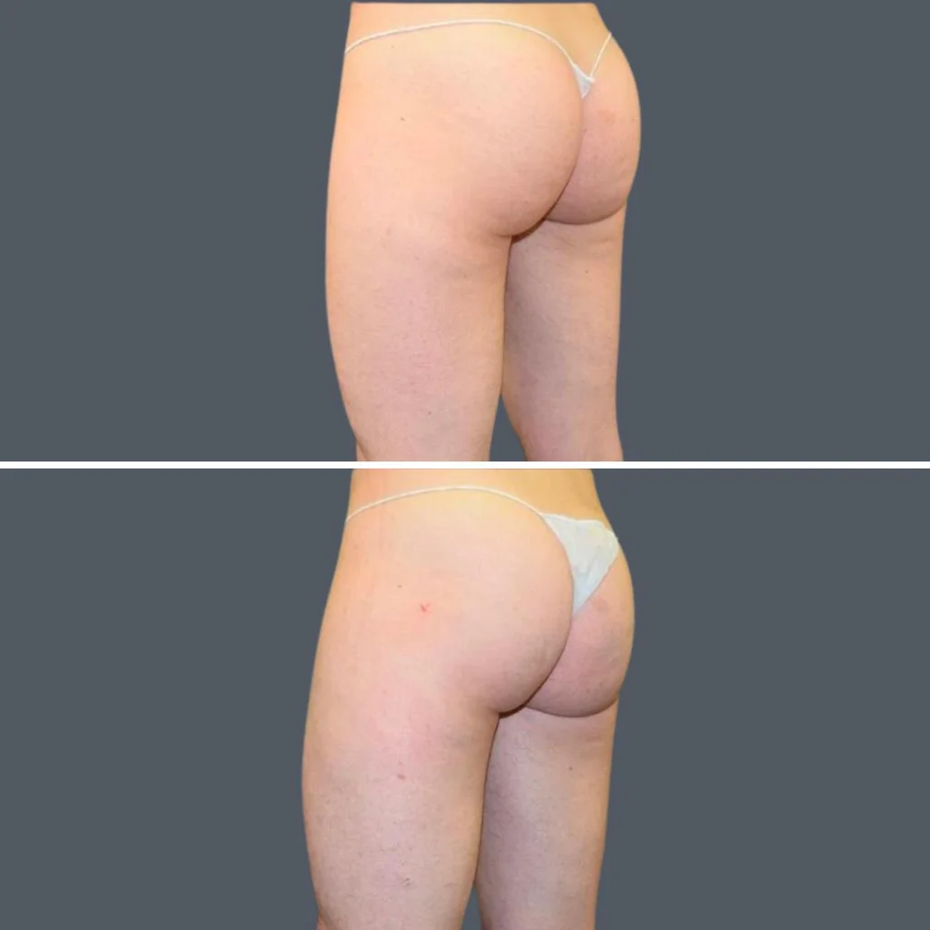 buttock reduction female pre2024 007 before and after before and after