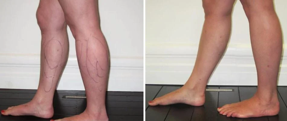 calf ankle liposuction female pre2024 008 before and after before and after