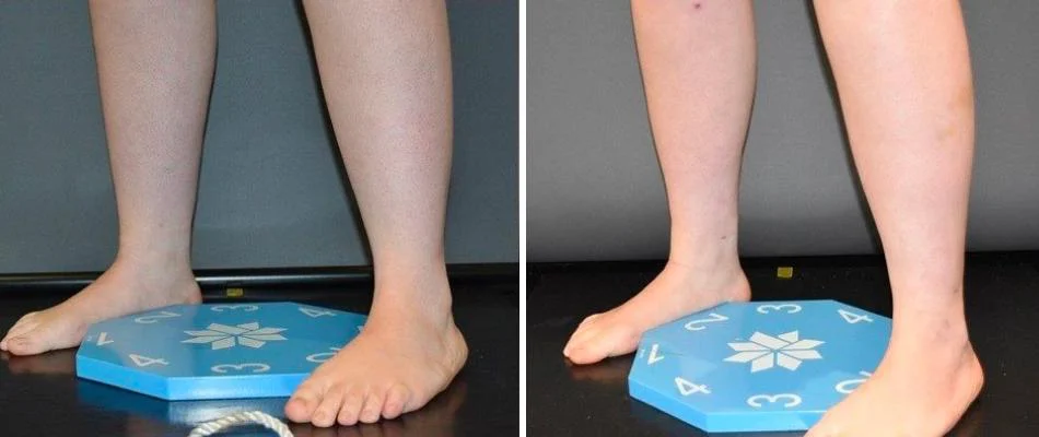 calf ankles coolsculpting liposuction female pre2024 011 before and after before and after