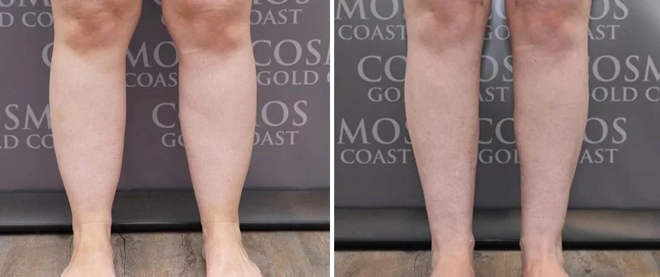 calf liposuction female pre2024 005 before and after before and after