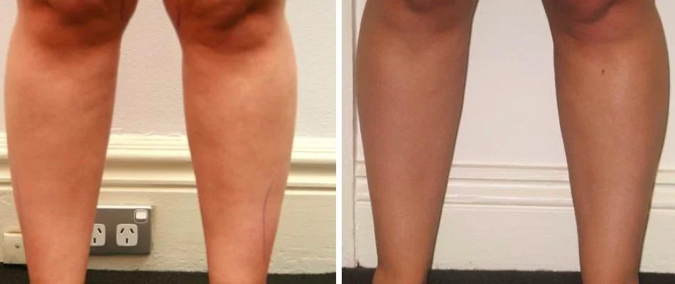 calf liposuction female pre2024 012 before and after before and after