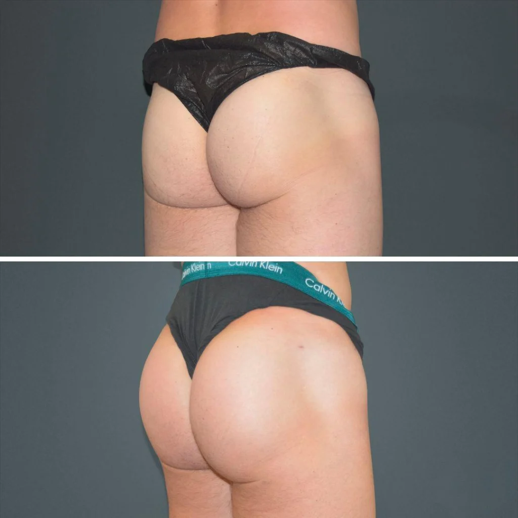 canberra bbl butt male 2022 left de before and after before and after