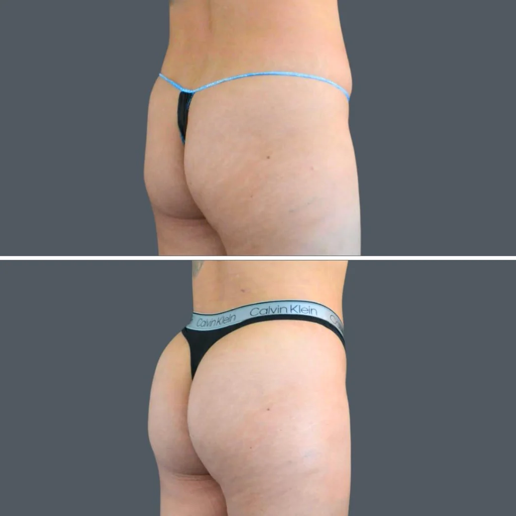 canberra bbl liposuction female 2024 kp 001 before and after before and after