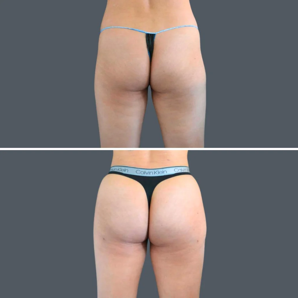 canberra bbl liposuction female 2024 kp 002 before and after before and after