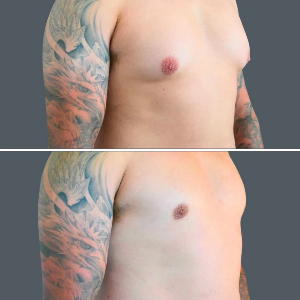 canberra gynecomastia male 2024 cm 002 before and after before and after