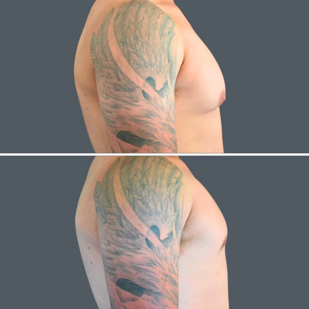 canberra gynecomastia male 2024 cm 003 before and after before and after