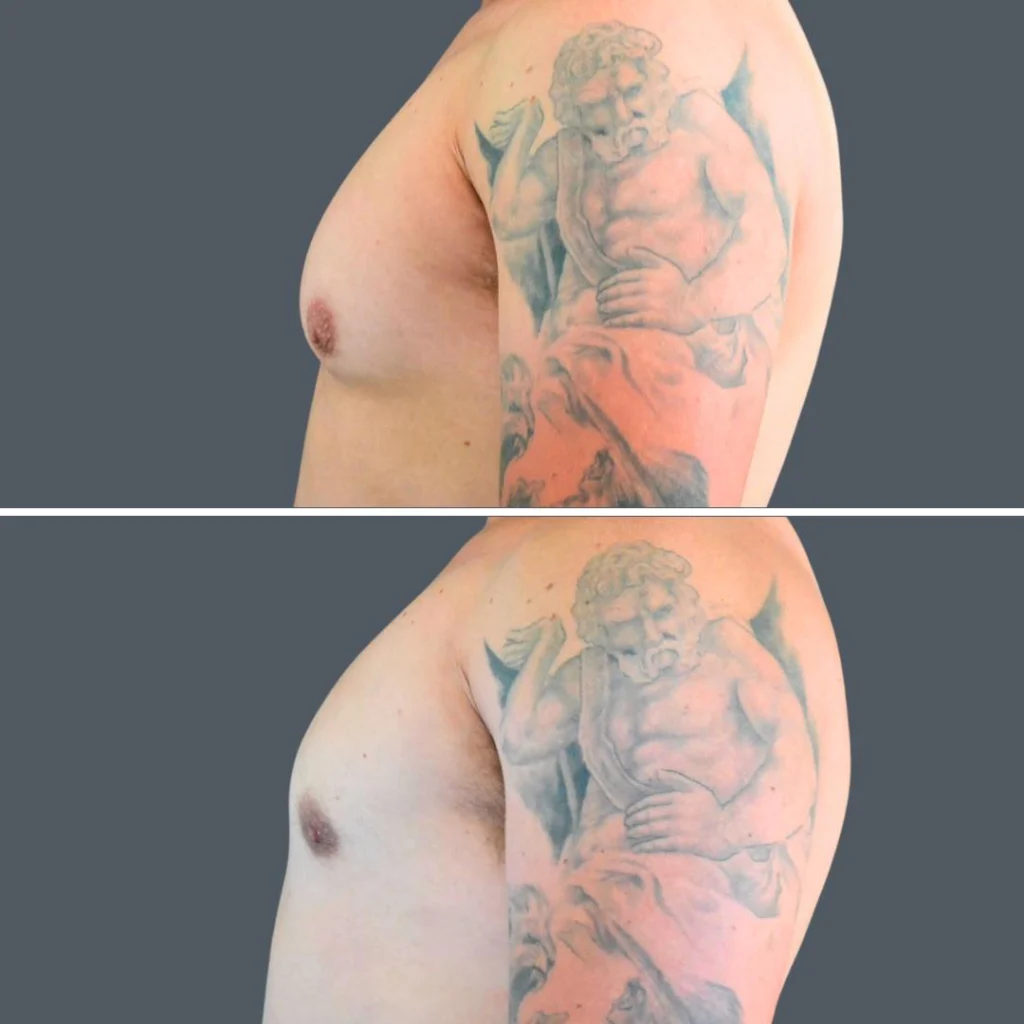 canberra gynecomastia male 2024 cm 004 before and after before and after