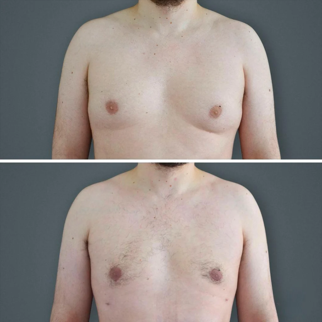 canberra gynecomastia male chest 2021 front ss before and after before and after