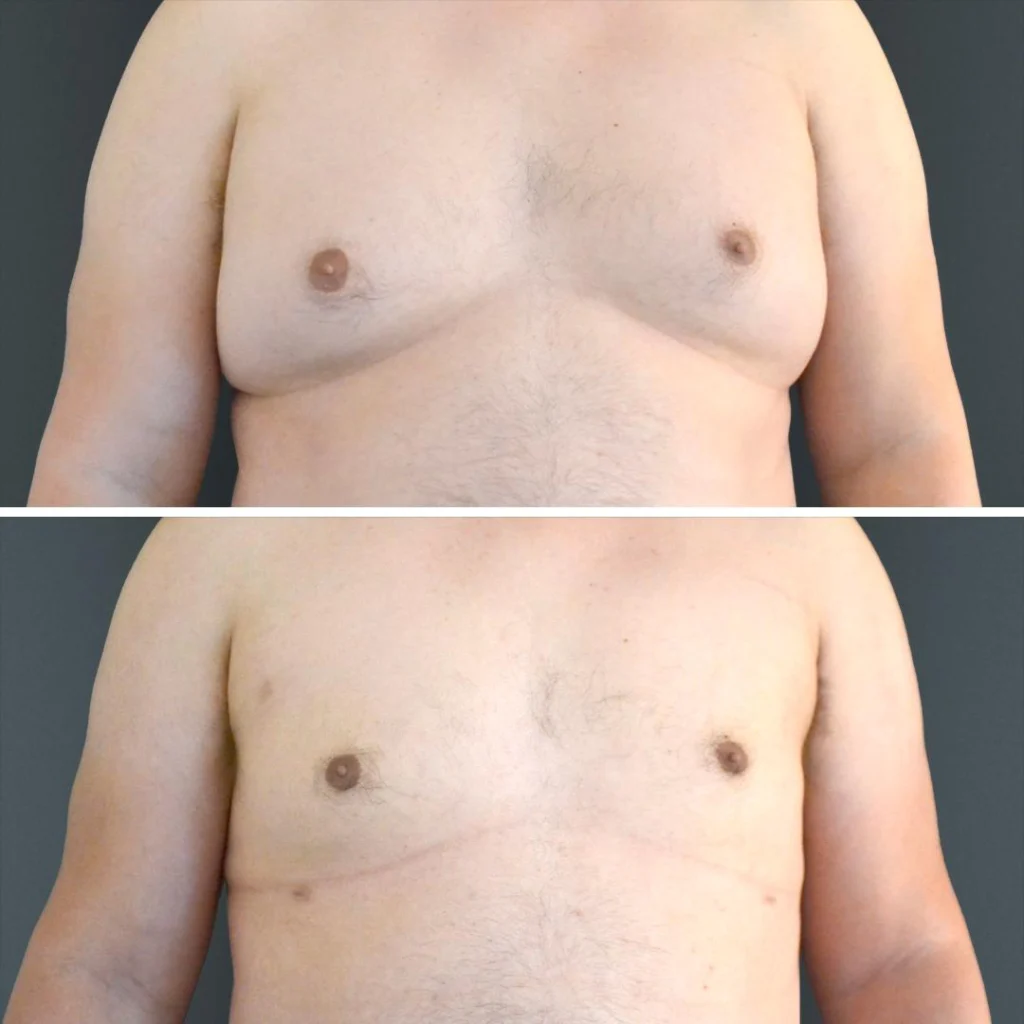 canberra gynecomastia male chest 2023 front tn before and after before and after