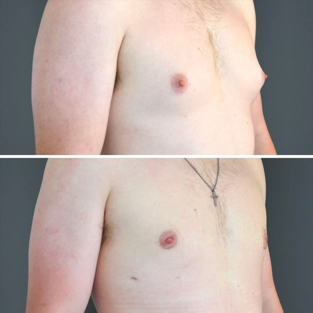canberra gynecomastia male chest 2023 left cp01 before and after before and after