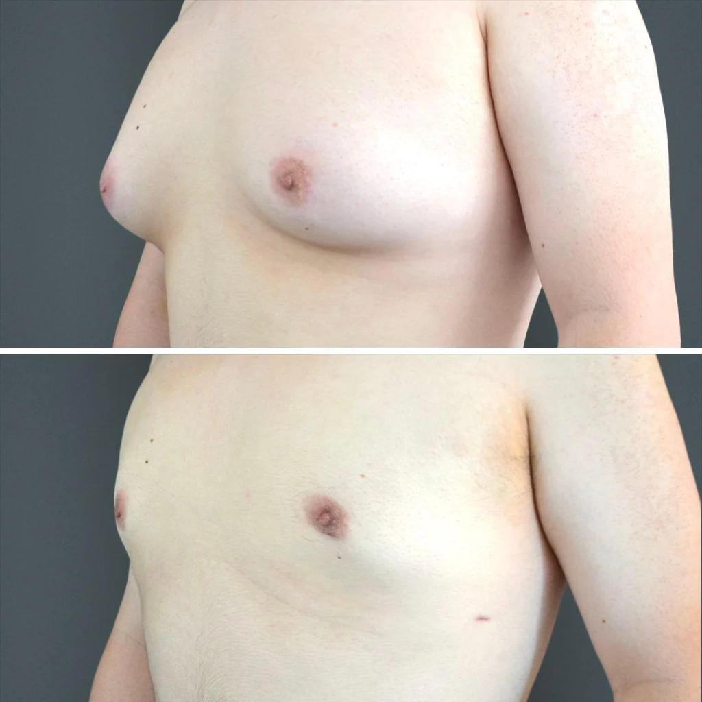 canberra gynecomastia male chest 2023 right cp02 before and after before and after