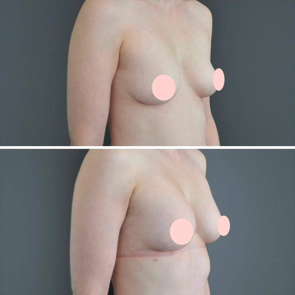 canberra liposuction breast female 2022 left sb before and after before and after