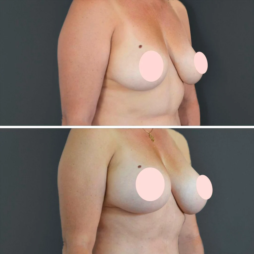 canberra liposuction breast female 2022 left ts before and after before and after