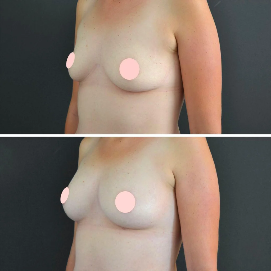 canberra liposuction breast female 2022 right et before and after before and after