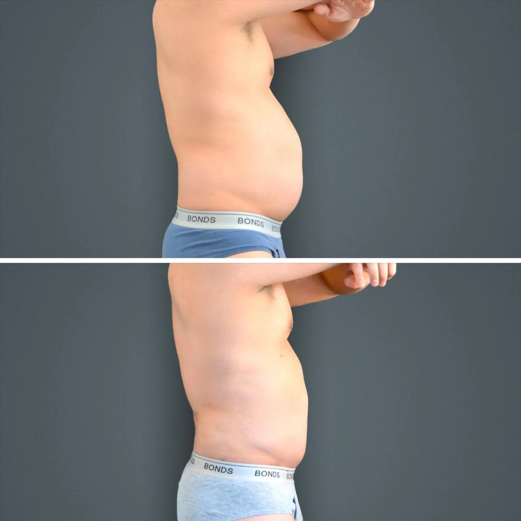 canberra liposuction stomach male 2023 left mv before and after before and after
