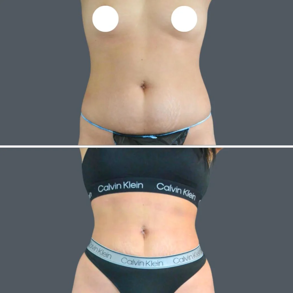 canberra stomach liposuction female 2024 kp 001 before and after before and after