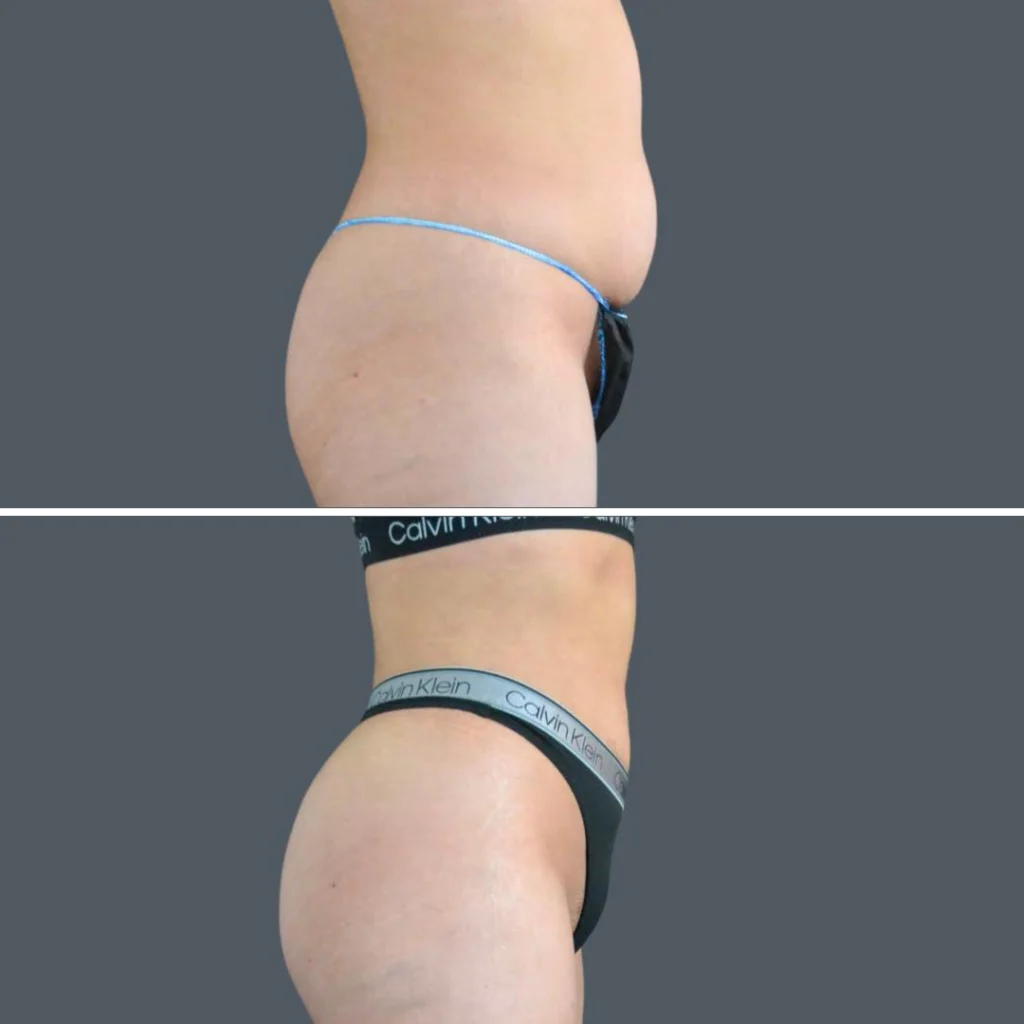 canberra stomach liposuction female 2024 kp 003 before and after before and after