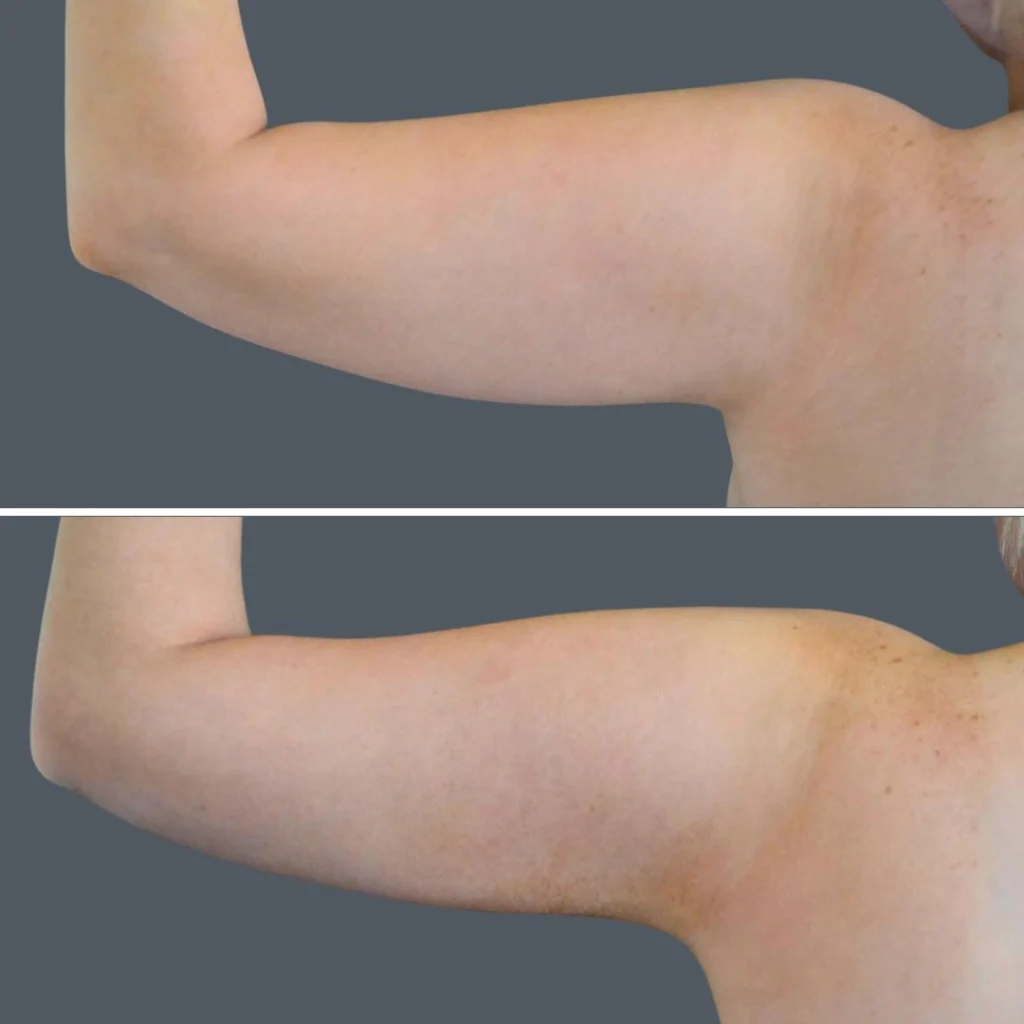 canberra vaser liposuction arms female 2024 cb 001 before and after before and after