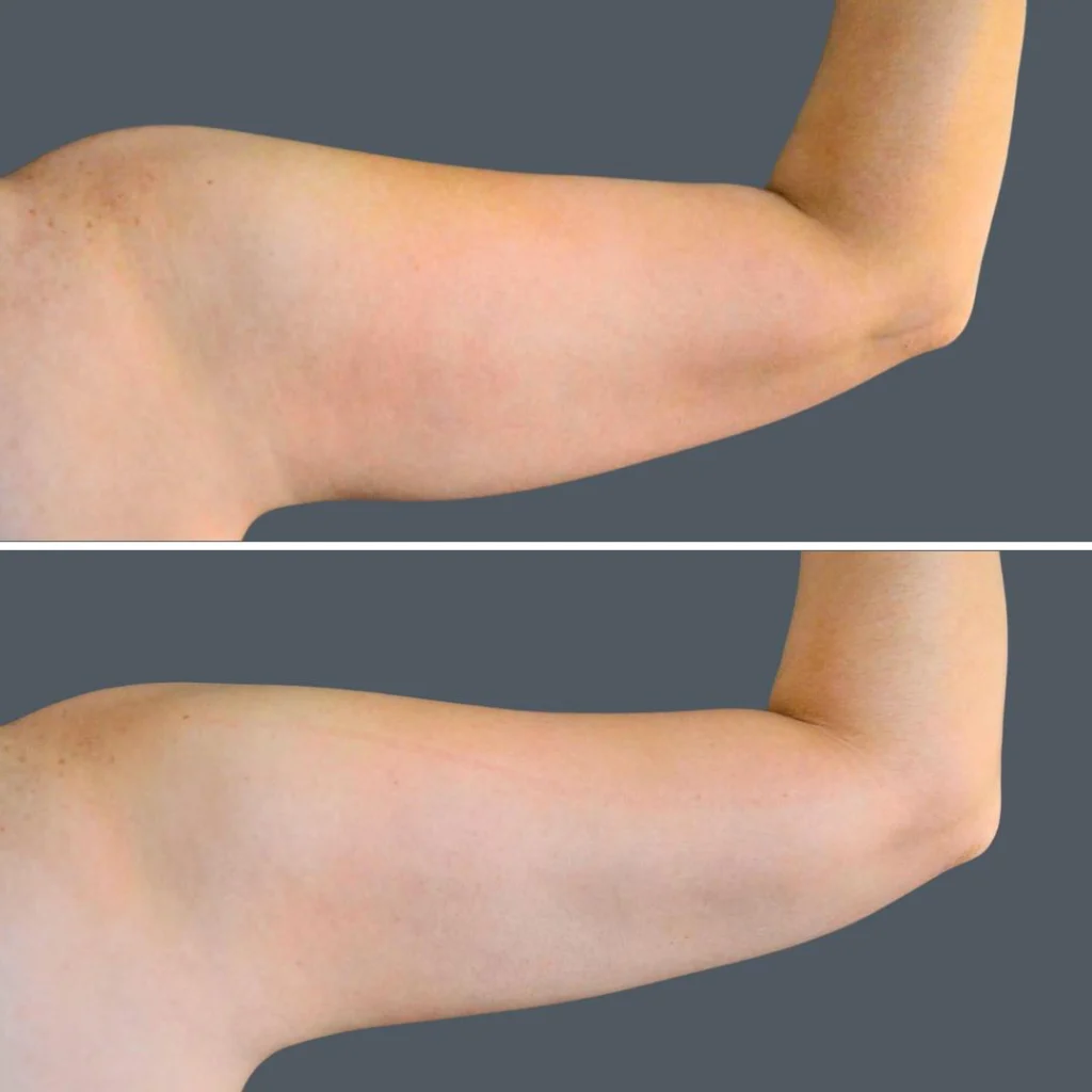canberra vaser liposuction arms female 2024 cb 002 before and after before and after