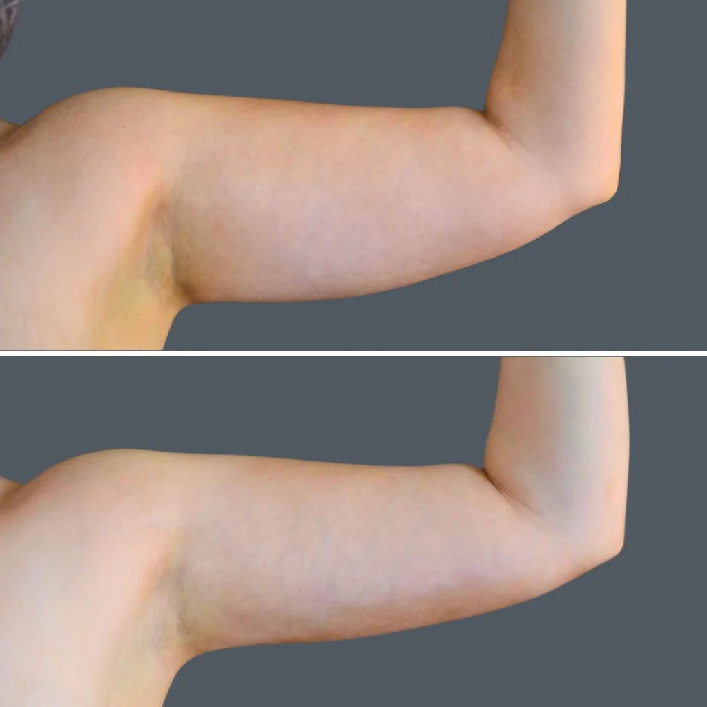 canberra vaser liposuction arms female 2024 cb 004 before and after before and after