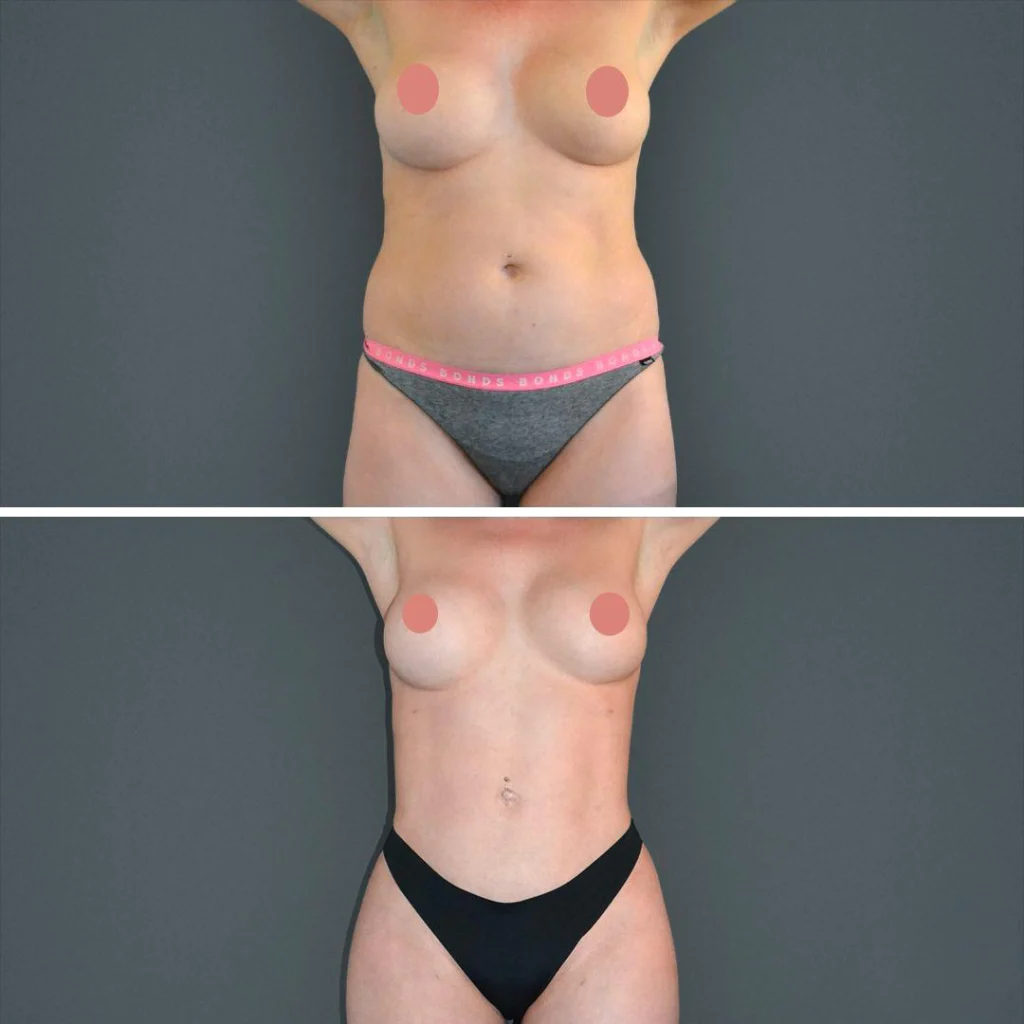 canberra vaserhidefliposuction stomach female 2022 front aw before and after before and after