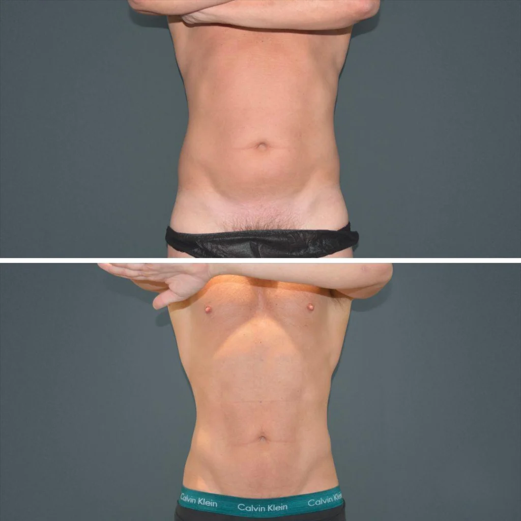 canberra vaserhidefliposuction stomach male 2022 front aw before and after before and after