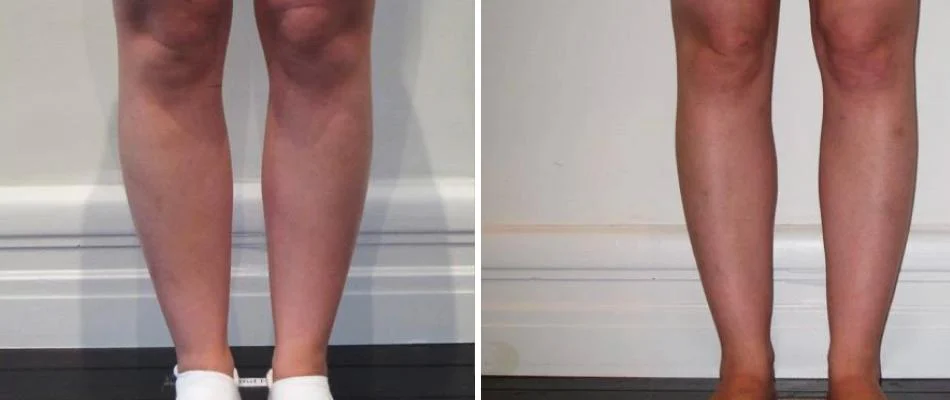 cankle liposuction female pre2024 002 before and after before and after