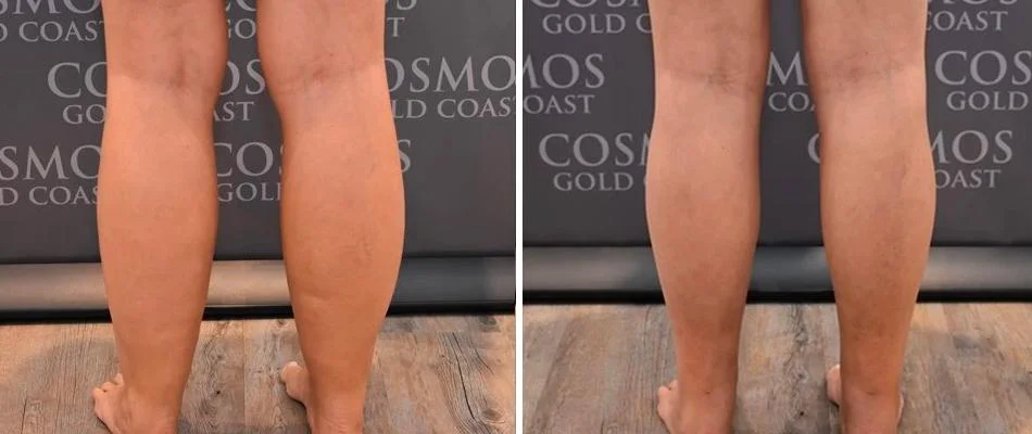 cankle liposuction male pre2024 004 before and after before and after