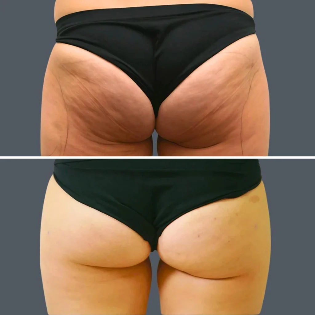 cellulite reduction female pre2024 003 before and after before and after