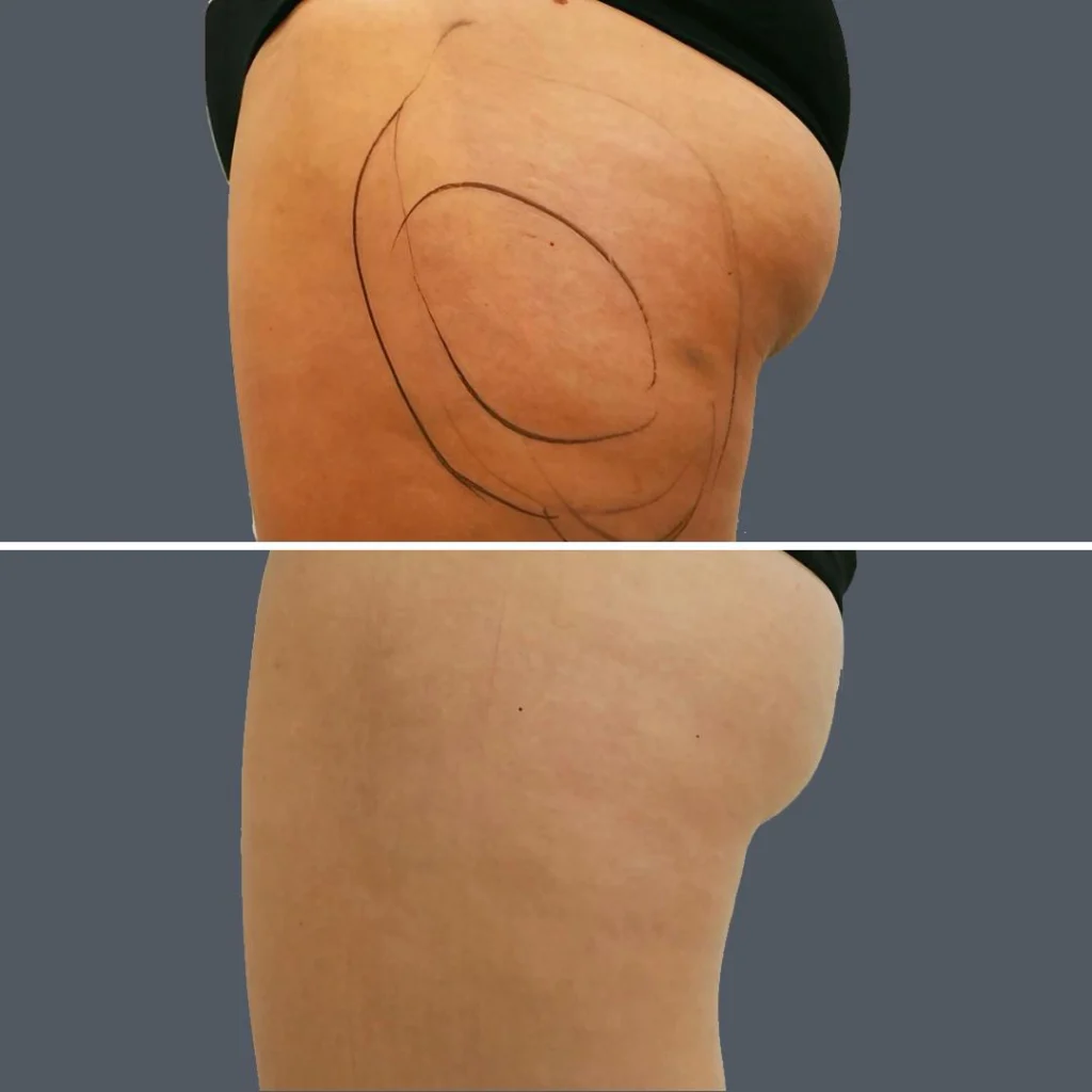 cellulite reduction female pre2024 004 before and after before and after