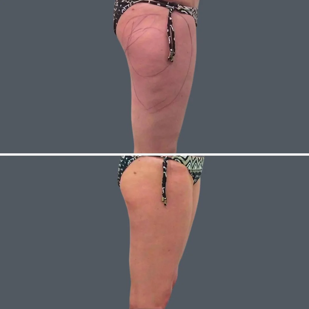 cellulite reduction female pre2024 006 before and after before and after