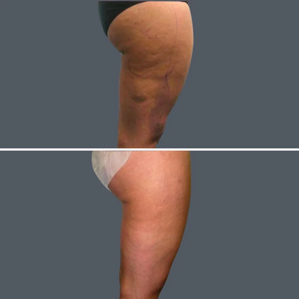 cellulite reduction female pre2024 009 before and after before and after