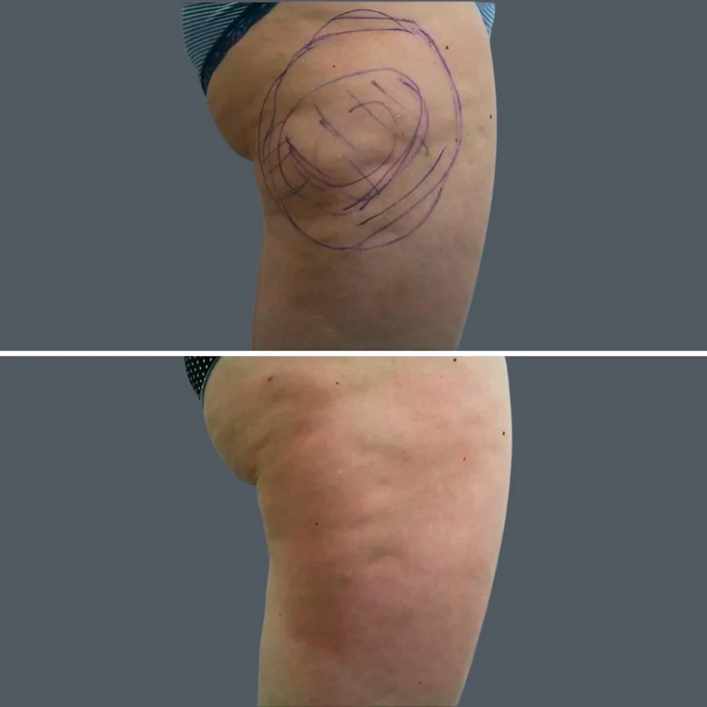 cellulite reduction female pre2024 010 before and after before and after